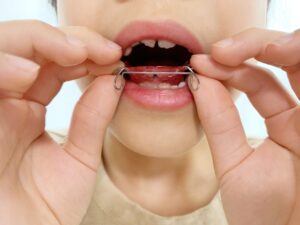 小児矯正　治療方法