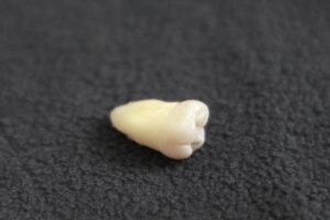 親知らず　抜歯